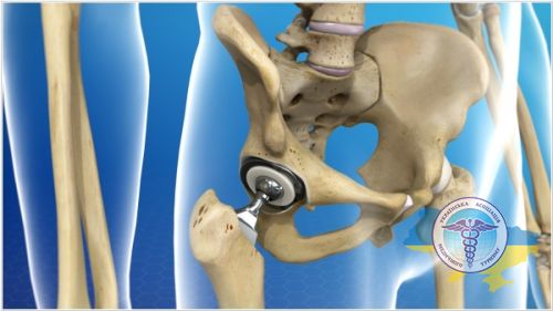 Joint replacement in Austria