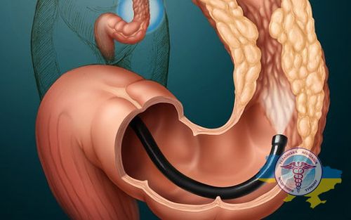Treatment of the large intestine in Germany