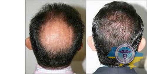 Hair transplant - photo before and after