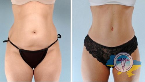 Liposuction of the abdomen