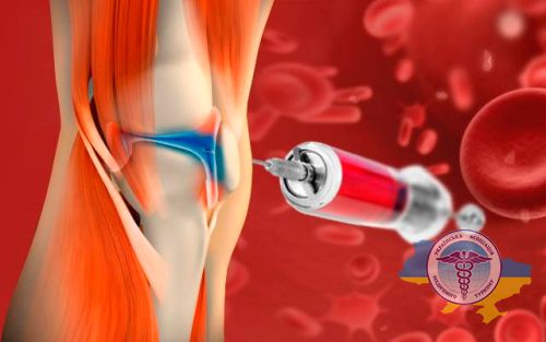 PRP therapy in orthopedics