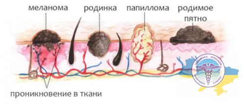 Меланома