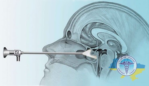 Transnasal surgery for brain tumor