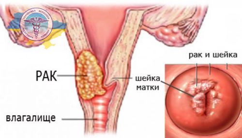 Cervical cancer