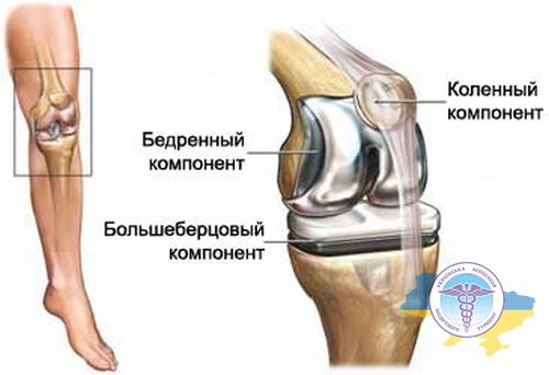 Knee arthroplasty in Latvia