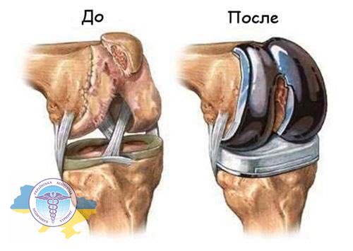 Prosthetic joints