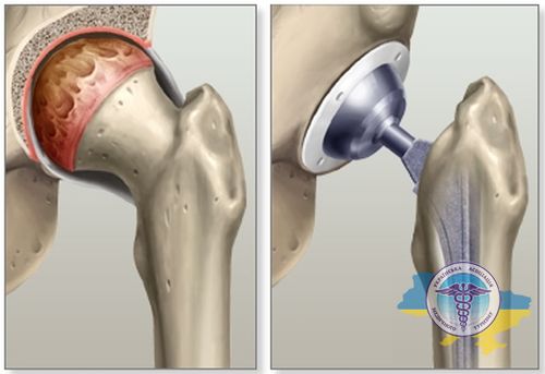 Hip replacement in Latvia