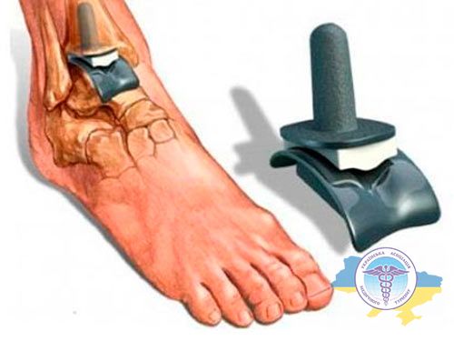 Ankle Endoprosthetics