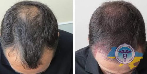 Пересадка волос в Турции до и после
