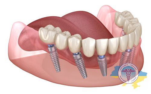 Тотальная имплантация зубов в Украине