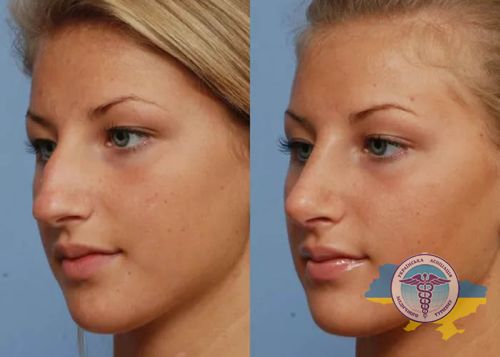 Before and after nose surgery