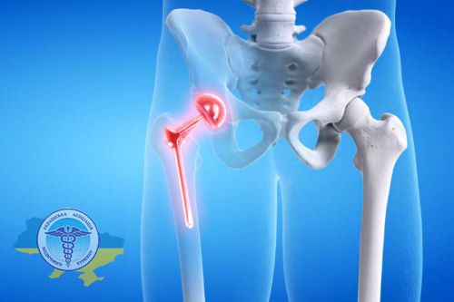 Endoprosthetics of joints abroad