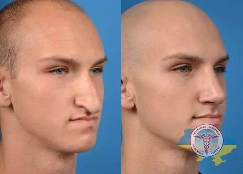 Коррекция носа - фото до и после