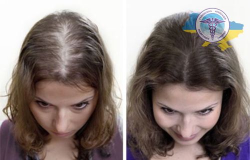 Пересадка волосся у жінок