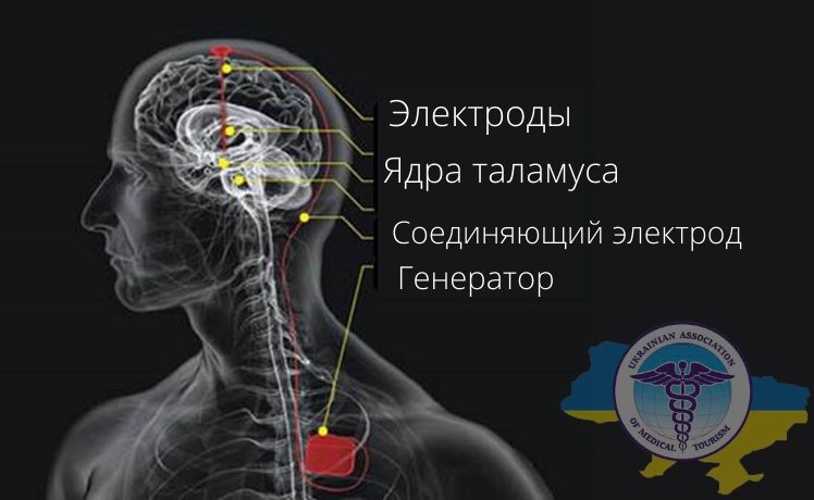 Схема глубинной стимуляции головного мозга