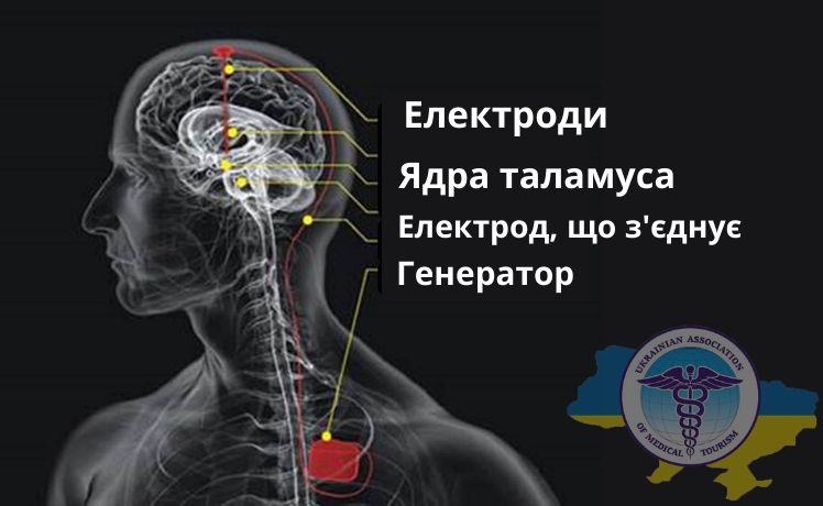 Схема глибинної стимуляції головного мозку