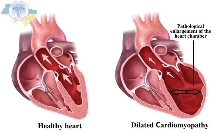 Healthy heart and heart with dilated cardiomyopathy