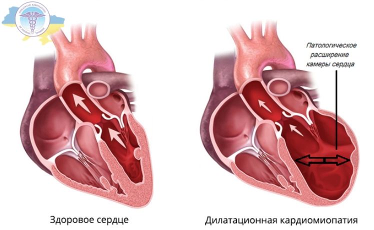 Здоровое сердце и сердце при дилатационной кардиомиопатии
