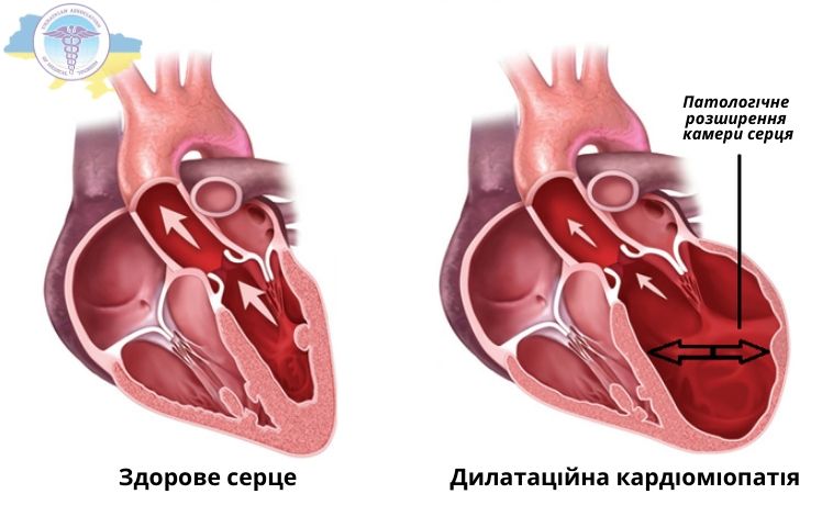 Здорове серце та серце при дилатаційній кардіоміопатії