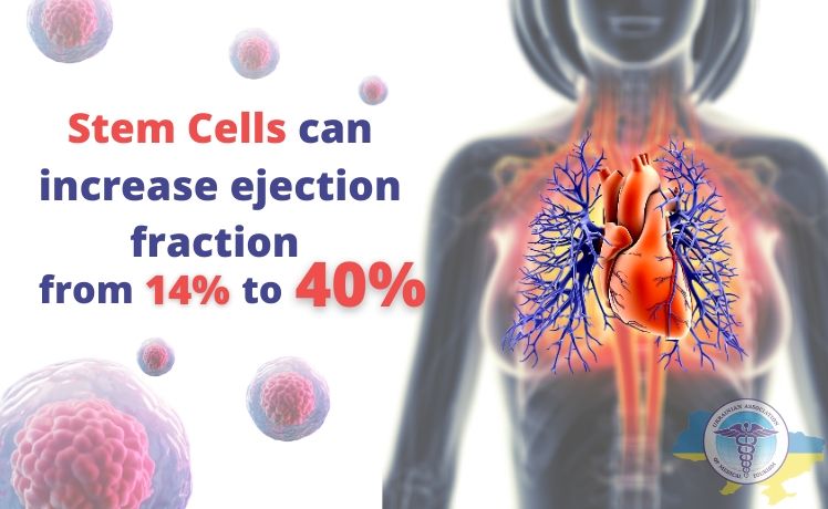 Unique results of treatment of dilated cardiomyopathy with stem cells