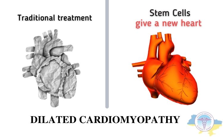 Classical treatment of dilated cardiomyopathy and stem cell treatment