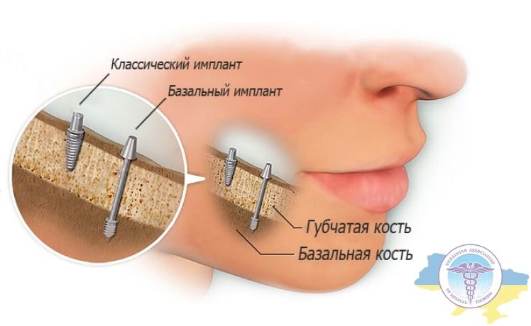 Отличия классической и базальной имплантации зубов