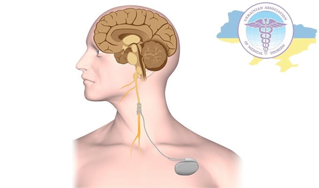 VNS therapy in the treatment of epilepsy